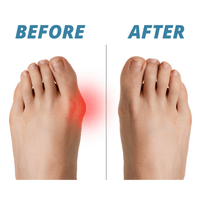 Thumbnail for Premium Bunion Corrector Sock